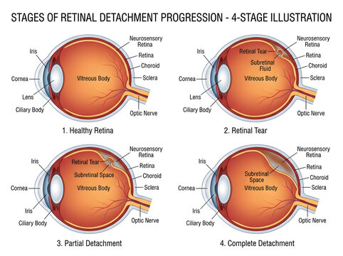 Stages of retinal detachment in human eye illustration isolated on white background