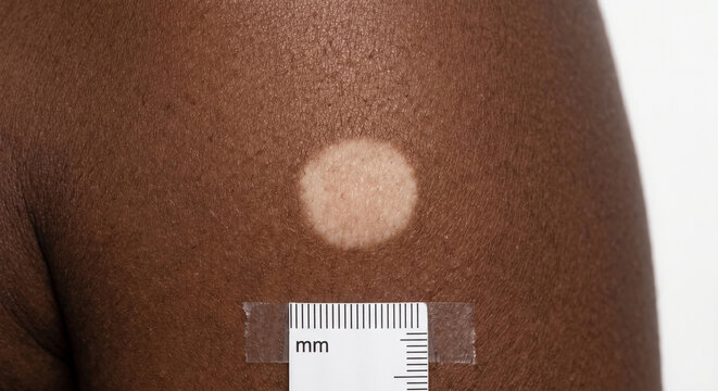 Macule on Fitzpatrick Type V Skin - Macule in Human Skin &mdash; Macule Plate (68-90)