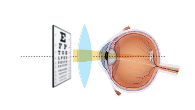 2D Hyperopia Correction Animation Farsightedness Vision Defect, Convex Lens Refraction, Human Eye Anatomy Diagram, Ophthalmology and Optometry Educational Medical Motion Graphic