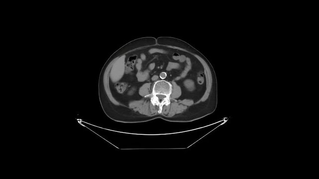 Non-Contrast CT Abdomen and Pelvis Axial 5 mm DICOM Medical Imaging Anatomy Loop