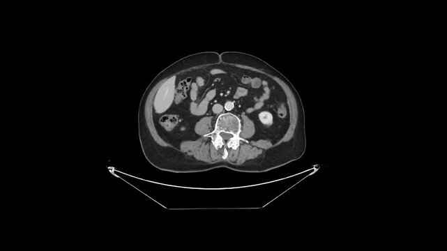 Contrast-Enhanced CT Abdomen and Pelvis Venous Phase Axial 1.25 mm DICOM Medical Imaging Anatomy Loop