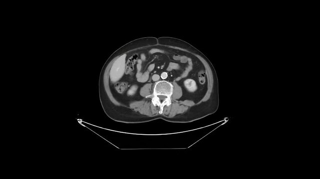Contrast-Enhanced CT Abdomen and Pelvis Venous Phase Axial 5 mm DICOM Medical Imaging Anatomy Loop