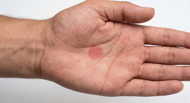 Palmar Macule - Macule in Human Skin &mdash; Macule Plate (55-90)
