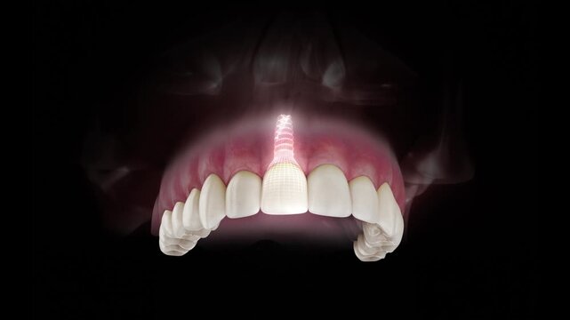 3D visualization of a dental implant of a maxillary central incisor with a transparent crown and visible gum anatomy on a black background.