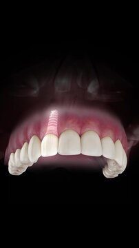 3D visualization of a dental implant of a maxillary lateral incisor with a transparent crown and visible gum anatomy on a black background.