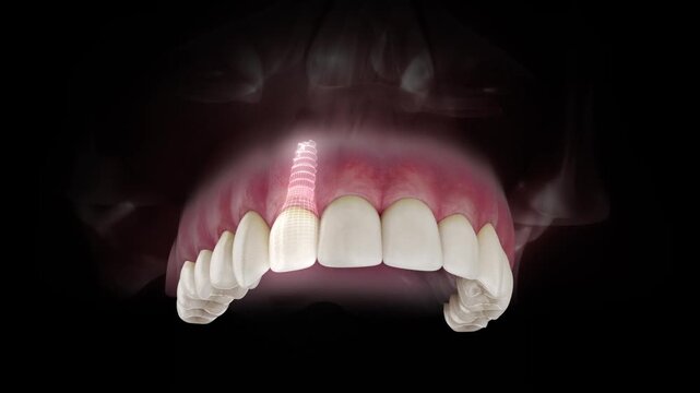 3D visualization of a dental implant of a maxillary lateral incisor with a transparent crown and visible gum anatomy on a black background.
