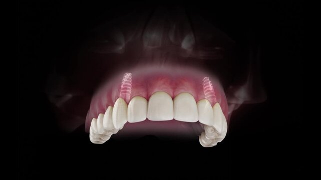 3D visualization of a dental implant of a maxillary both canines with a transparent crown and visible gum anatomy on a black background.