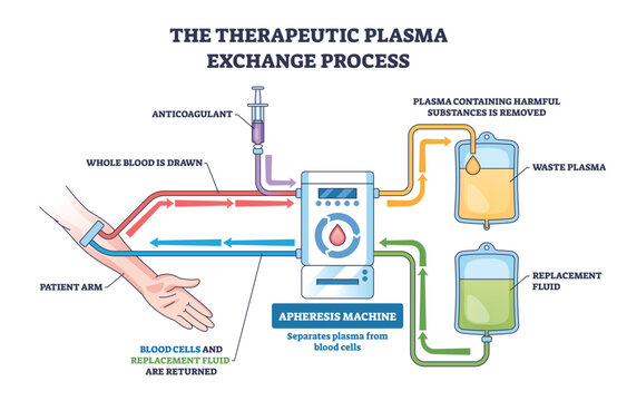 Therapeutic plasma exchange process illustrated, blood from patient arm enters apheresis machine, waste plasma removed and replacement fluid returned, key, machine, arm, plasma bags. Outline diagram