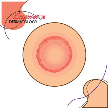 Illutration common skin condition of ringworm
