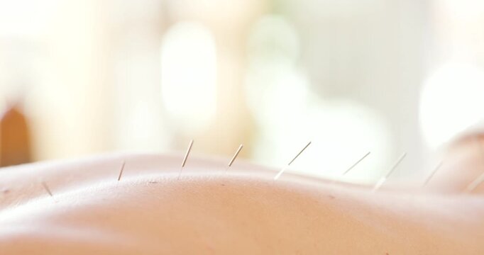 Closeup of back with acupuncture needles. Unrecognizable woman lying in a health clinic getting traditional treatment and alternative care in a beauty spa. Holistic remedy for back and spinal injury