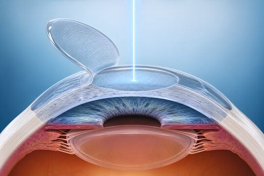 Laser vision correction corneal flap procedure illustration