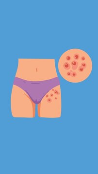 fungal groin infection animation