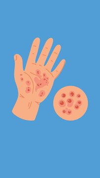 fungal infection on hand animation