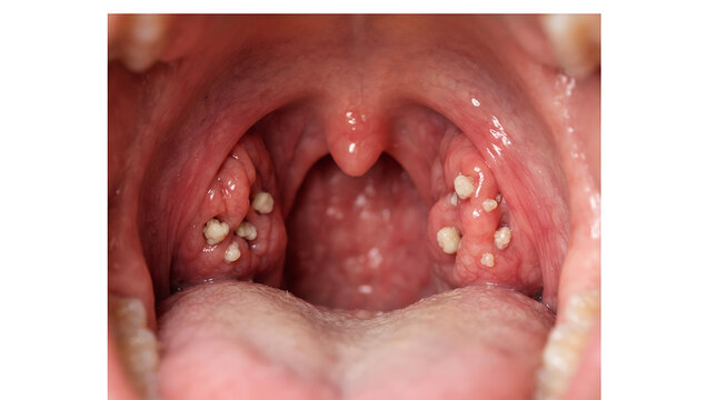 Bilateral tonsils with visible white tonsil stones