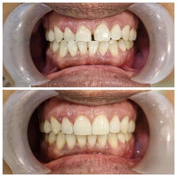 Before and after dental procedure showing successful midline diastema closure.