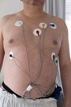 Man with heart monitoring equipment on chest.  Unrecognizable patient wearing holter monitor device