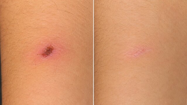 Skin wound healing process before and after comparison