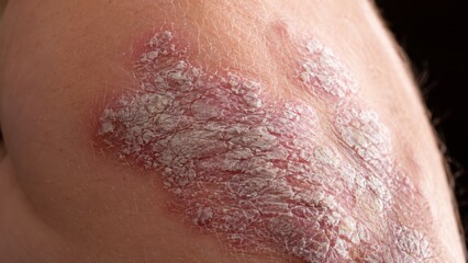 Fototapeta premium Macro of silvery flaky psoriasis plaques on a knee