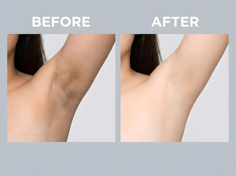 underarm lightening before and after | dark armpit treatment results | laser hair removal underarms | skin whitening for armpits | smooth underarm skin transformation