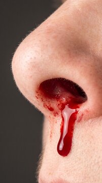 Nosebleed blood dripping from nostril, extreme macro close up of active epistaxis with fresh red blood