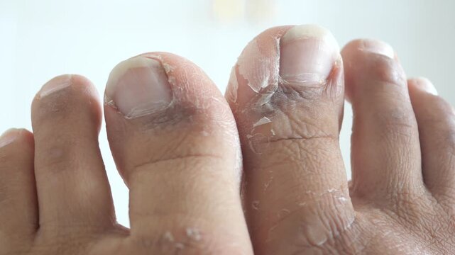 Close-up motion footage of toes with dry peeling skin and thickened nails