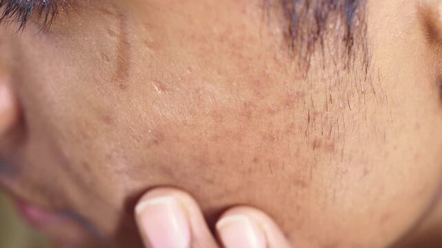 Close up video of facial skin with acne scars and dark spots on cheek being examined by hand