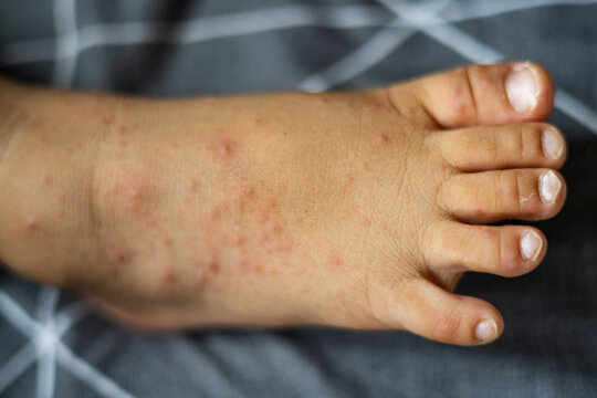 Red Rash On Toddler Foot From Hand Foot Mouth Disease