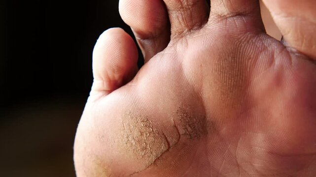 Close up extreme shot of dry cracked foot sole with rough skin texture showing details