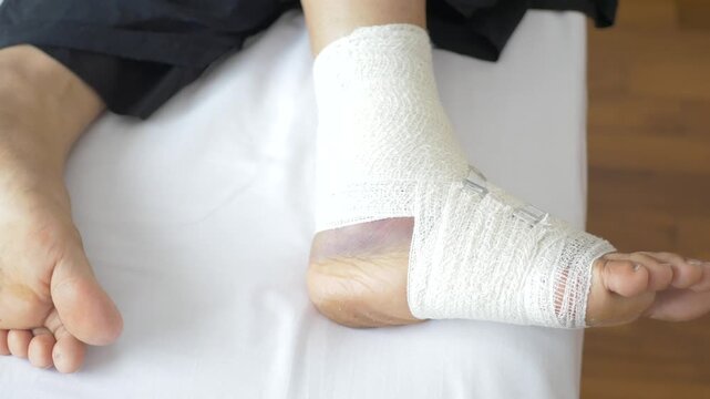 A close up view of an injured foot wrapped in a white bandage with metal clips, indicating recovery after an accident or injury in a medical setting