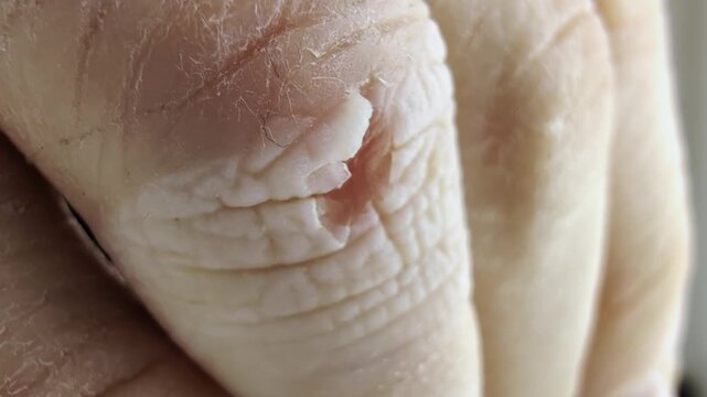 Close-up of dry human finger with severe peeling skin on knuckle revealing tender reddish area underneath. Skin damage on hand with flaky texture.