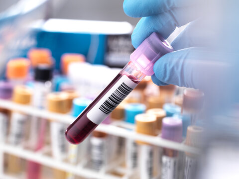 Medical technician preparing a human blood sample for clinical testing