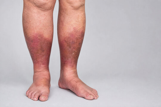 Lipodermatosclerosis with Inverted Champagne Bottle Deformity of the Lower Legs