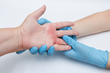 Fototapeta premium Medical examination of a patient's hand affected by skin inflammation or dermatitis, close-up, doctor wearing blue nitrile gloves.