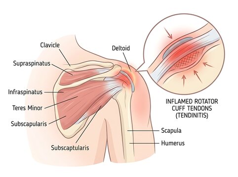 Inflamed rotator cuff tendon medical diagram with shoulder