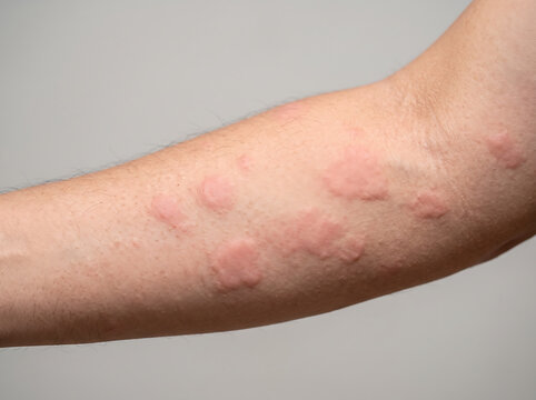 Close-up of raised red hives on a person's forearm, showing itchy welts caused by allergy, urticaria, insect bites, skin irritation, or inflammation symptoms.