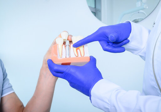Dentist explaining dental implant procedure with tooth model during patient consultation in modern dental clinic