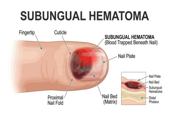 Medical illustration showing blood trapped beneath nail plate after trauma.
