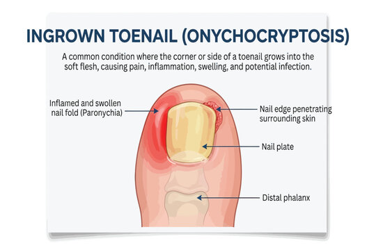 Medical illustration showing inflamed ingrown toenail penetrating soft tissue.