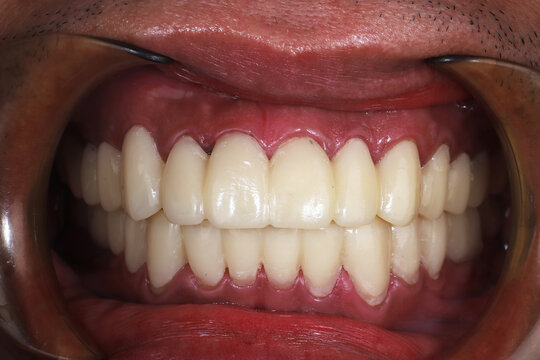 Close up of full mouth temporary dental bridge and acrylic crowns after prosthodontic smile makeover treatment.