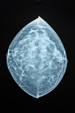Bilateral mammogram film in Craniocaudal CC view. Low-dose X-ray of female breast tissue. Used to detect early signs of breast cancer during routine preventative medical screening