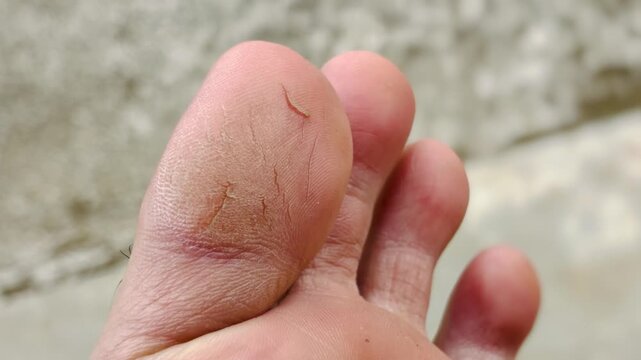 Close-up of dry, cracked soles of the feet that need treatment.
