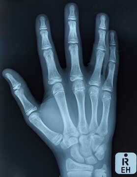 Anteroposterior X-ray showing right hand anatomy of teen male patient, displaying developing bone structure, growth plates, fingers, metacarpals, phalanges, and wrist joints