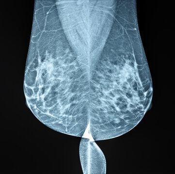 Bilateral mammogram, in Mediolateral Oblique MLO view. Low-dose X-ray. Female breast tissue. Used to detect early signs of breast cancer during preventative screening