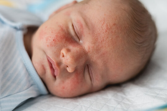 Close up of a sleeping newborn baby with red skin rash or neonatal acne on cheeks and forehead.