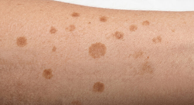 Multiple scattered discrete flat macules on human skin - Macule Plate (71-90)