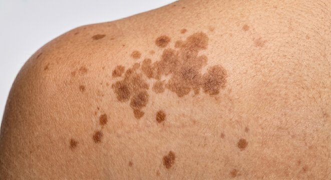 Confluent Macules on Human Skin  - Macule Plate (75-90)