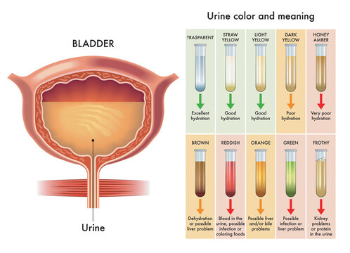 Medical diagram of urine color and meaning.