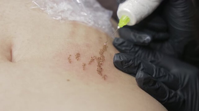 Cosmetic practitioner performs plasma pen treatment on facial skin, Close view shows a precise dotted pattern forming across the treatment area