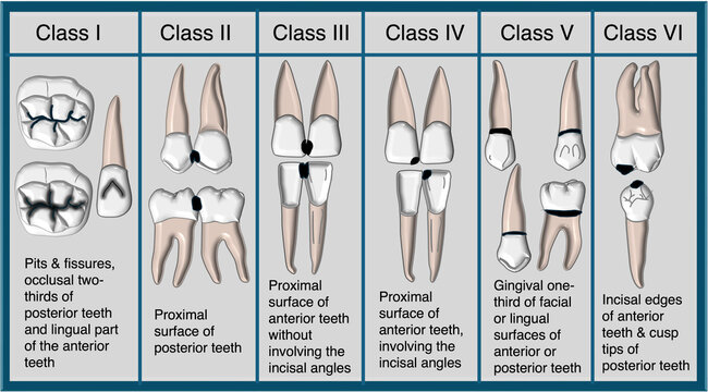 G V Black classification of Dental Caries and Cavity Preparation diagram