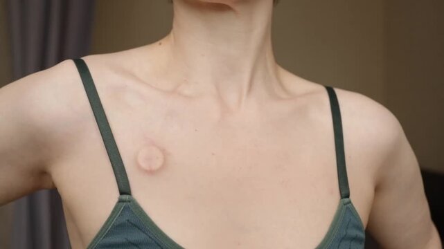 cancer survivor with a visible chest port and copy space, showing real patient experience, recovery, confidence and life after chemotherapy